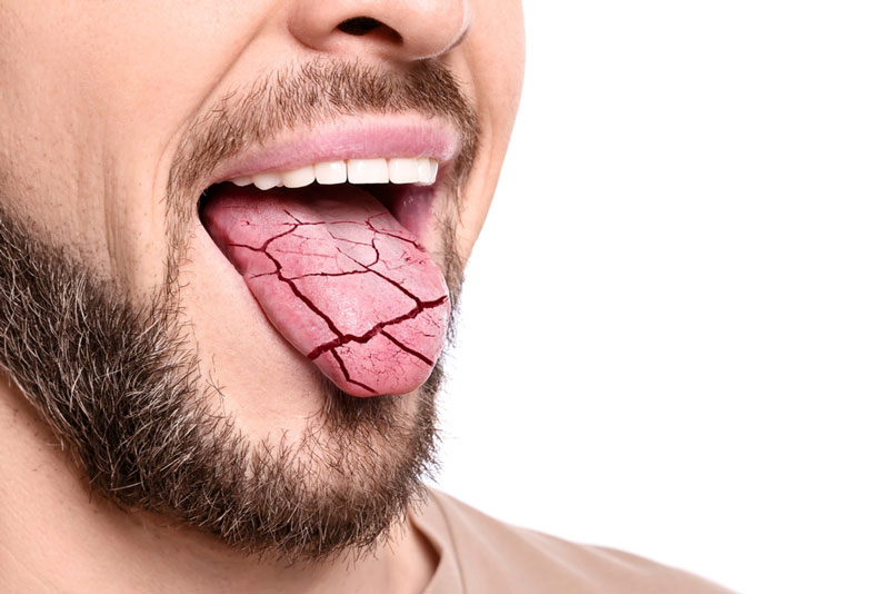 Close-up of a man with a dry, cracked tongue sticking out, illustrating symptoms of dry mouth or dehydration.