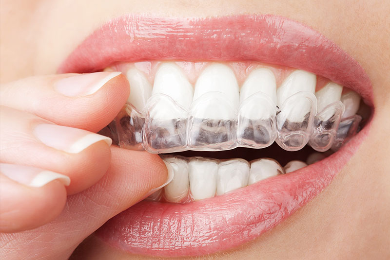 Where can I get Plaiview Invisalign?