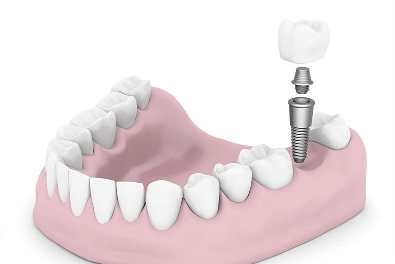 Plainview Dental Implants