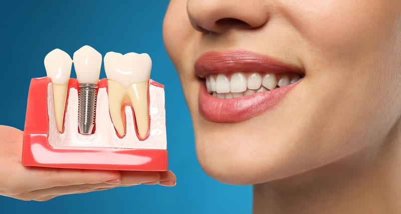 Revolutionizing Smiles: The Power of All on 4 Dental Implants in Port Washington, NY