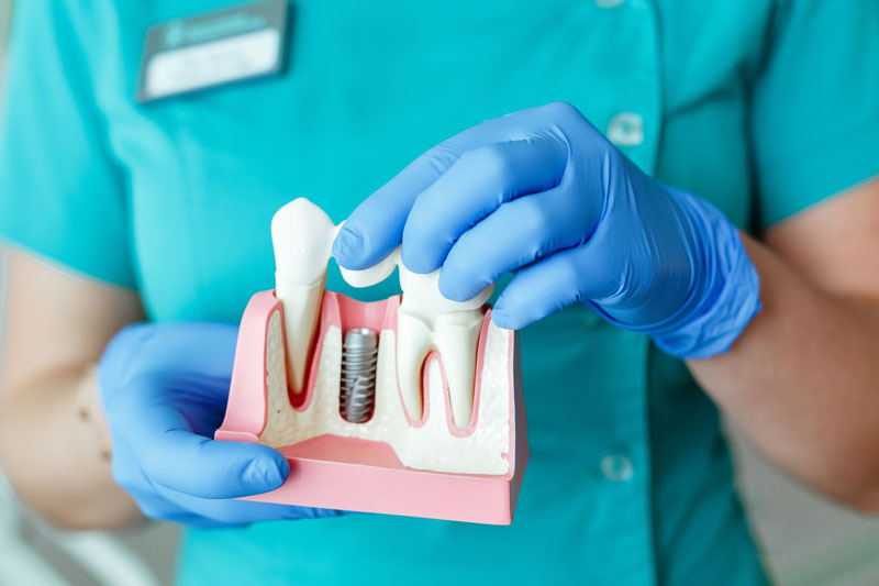 Unpacking Dental Implants: What’s an Implant, How It Works, and Its Lasting Benefits